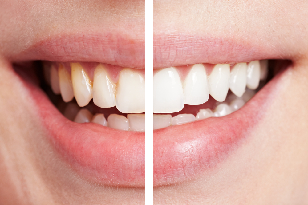 teeth whitening laser cons pros dental dentistry para results dents whiting vs veneers smile