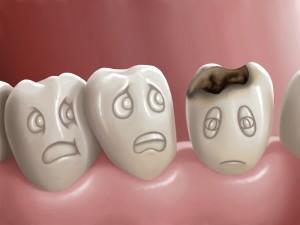 Cavities and Fillings at a Roseville Dentist
