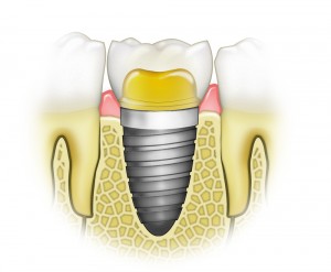 Dental Implants May be Right for You